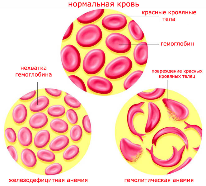 Тест болезни крови. Аутоиммунная гемолитическая анемия картина крови. Гемолиз эритроцитов при анемии. Гемолитическая анемия эритроциты форма. Гемолитическая анемия микроскопия эритроциты.
