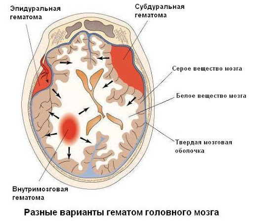 Можно ли выжить после кровоизлияние в мозг