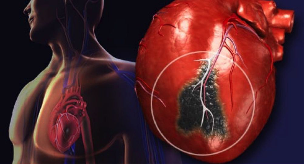 Инфаркт миокарда на картинке