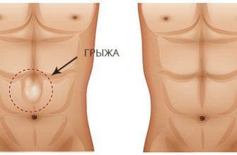 Грыжа прямой мышцы. Грыжа белой линии живота и диастаз. Диастаза мышц живота пупочной грыжи. Грыжа белой полосы живота.